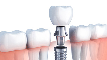 Ways To Get Cheap Dental Implants And Save On US Dental Care