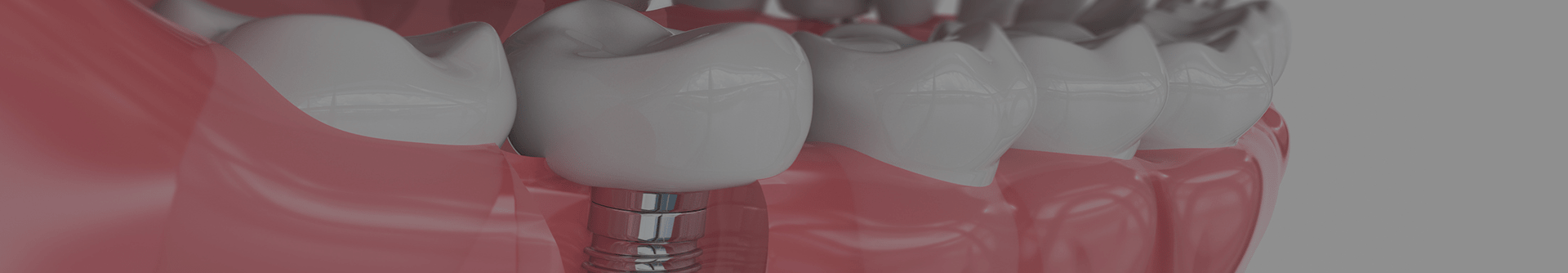 The Average Prices For A Single Tooth & Full Mouth Implants